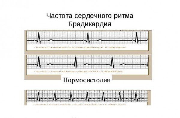 ЭКГ при брадикардии и нормальной работе сердца