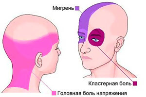 golovnaya-bol-napryazheniya-simptomy-i-lechenie