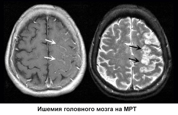 Ишемия на МРТ