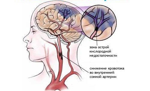 Ишемический инсульт