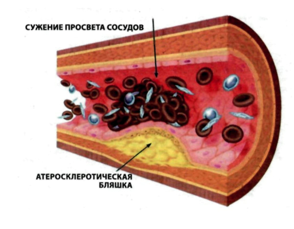 Атеросклеротическая бляшка