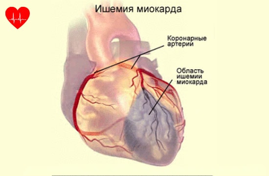 Ишемия миокарда