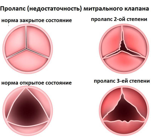 Неполное закрытие митрального клапана