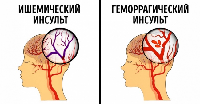 Виды инсульта