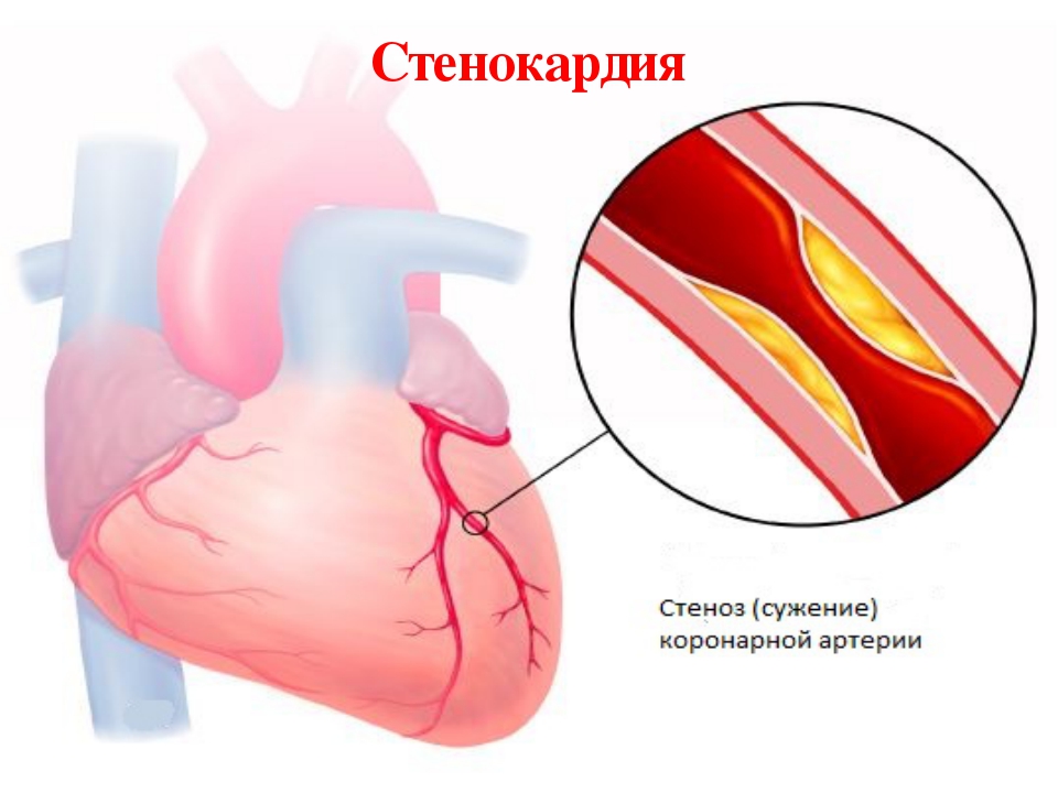 Кислородное голодание сердечной мышцы