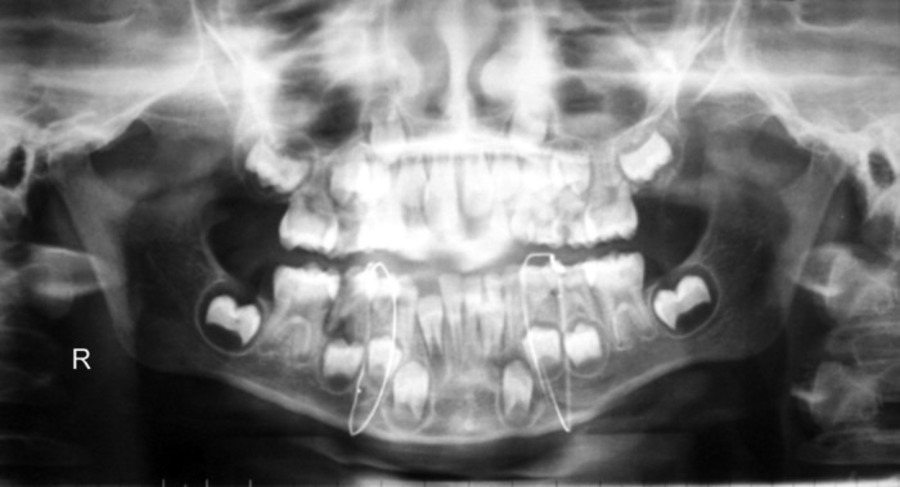 «Засвеченные» металлические конструкции на верхнем и нижнем зубных рядах, снимок МРТ