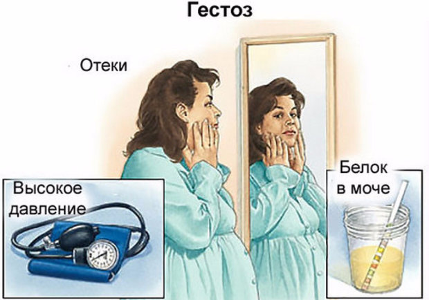 Гестоз