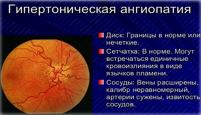 как выглядит ангиопатия сетчатки глаза