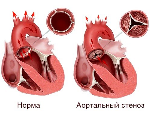 Аортальный порок сердца
