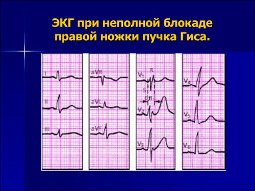 Результат ЭКГ