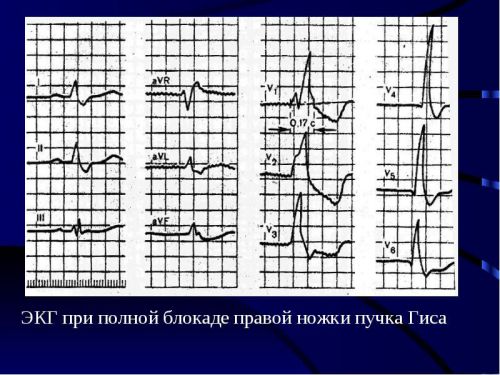 Результат ЭКГ