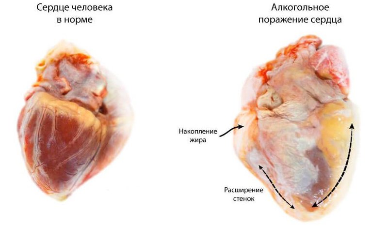 kardiomiopatija-alkogolnaja