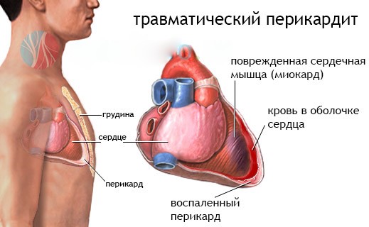 travmaticheskiy-perikardit