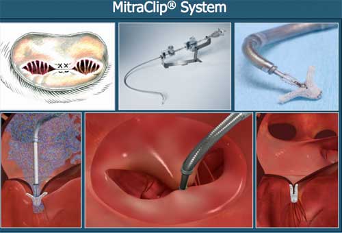 MitraClip-System
