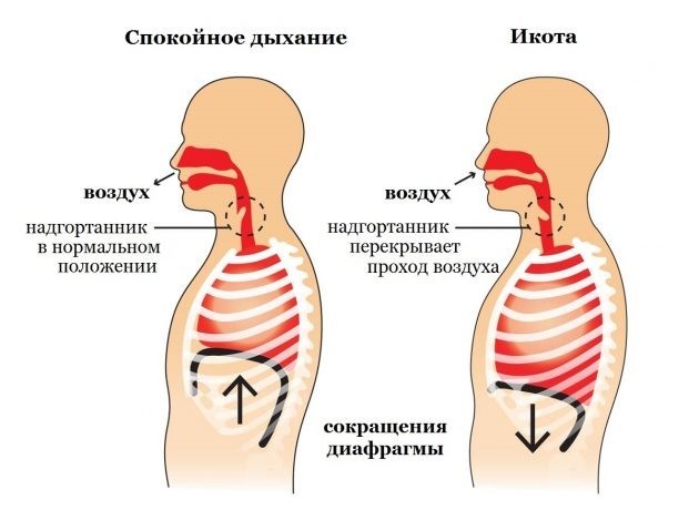 Икота-икота: О каких заболеваниях расскажет икота? 