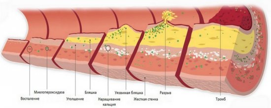 Атеросклероз сосуда
