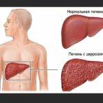 Симптомы и признаки болезни печени у мужчин