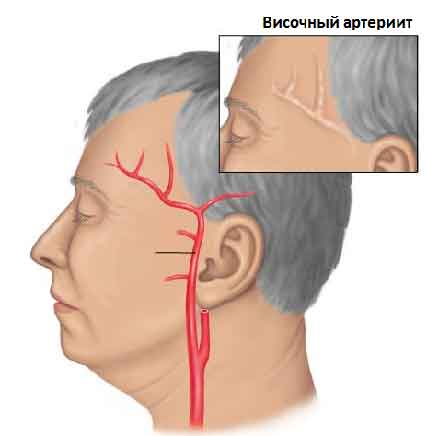 temporal-arthritis-338