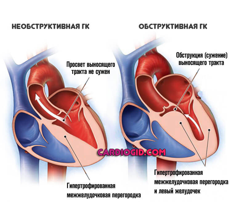 гипертрофическая-кардиопатия-обструктивная-и-необструктивная