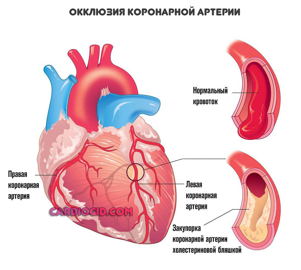 окклюзия-коронарной-артерии