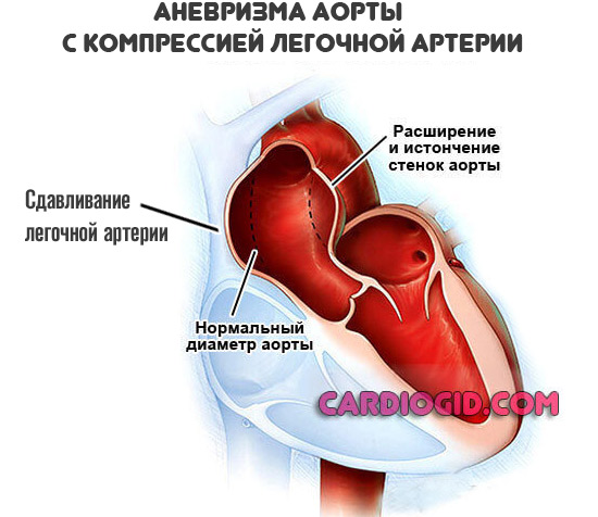 аневризма-аорты-с-компрессией-легочной-артерии