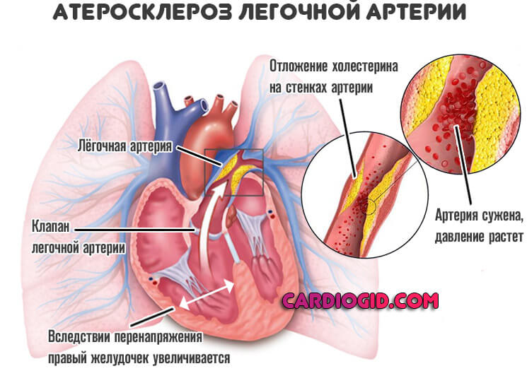 атеросклероз-легочной-артерии