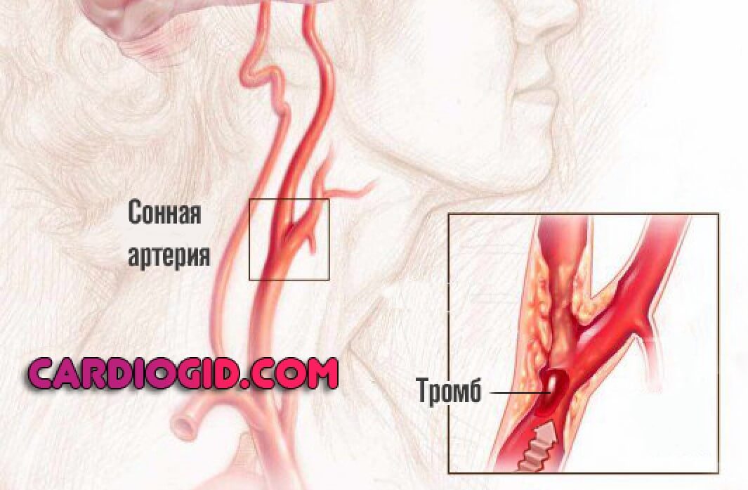 тромбоз сонной артерии