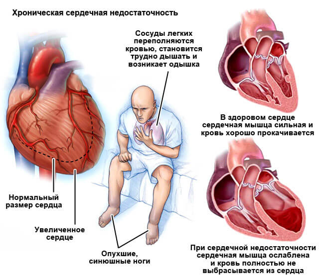 инфаркт сердца