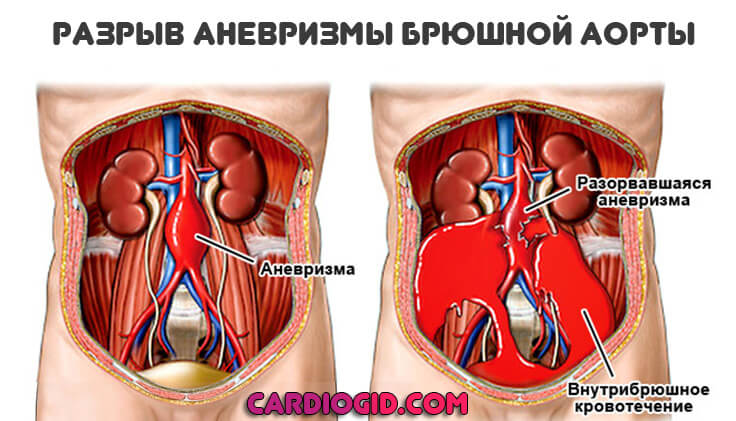 разрыв-аневризмы-брюшной-аорты