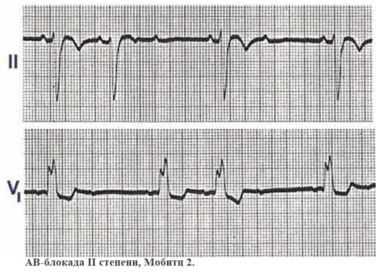 АВ-блокада II степени, Мобитц 2.