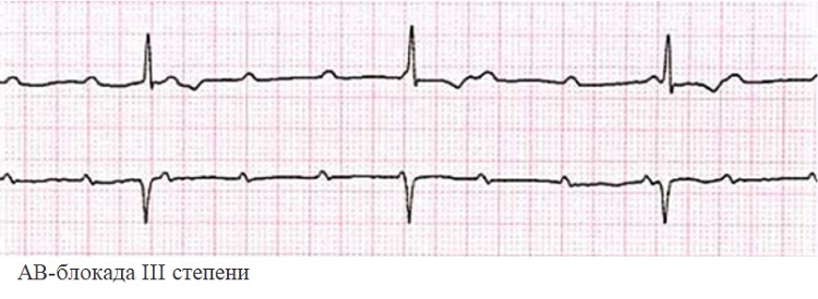 АВ-блокада III степени