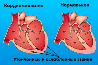 Причины возникновения кардиомиопатии