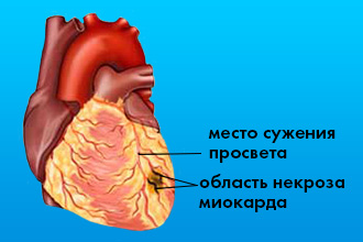 Что такое мелкоочаговый инфаркт миокарда