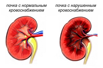 Как выглядят здоровые и больные почки