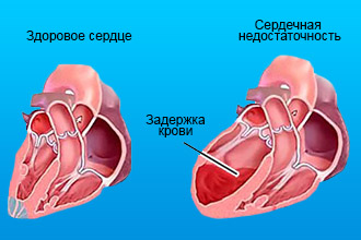 СЛН