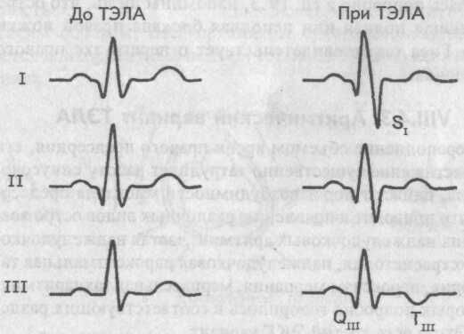 Электрокардиографический синдром SI-QIII-TIII