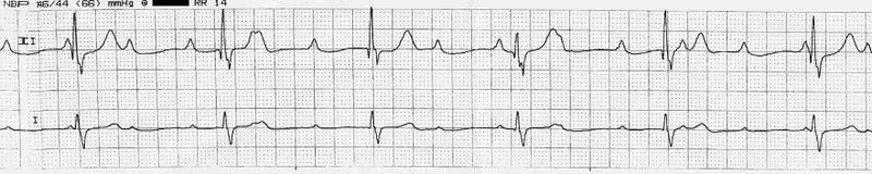 ЭКГ при полной АВ-блокаде.
