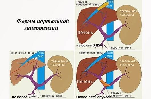 Виды билиарной гипертензии