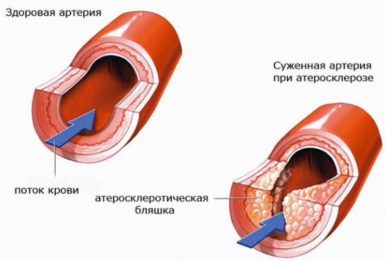 Атеросклероз при гипертонии