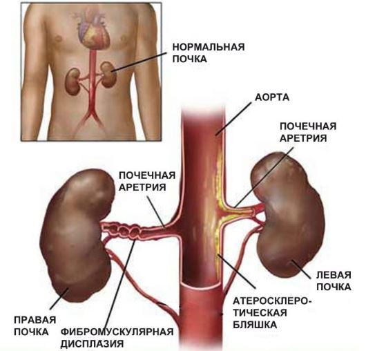 Фибромускулярная гиперплазия