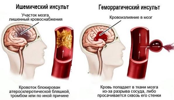 Виды инсультов