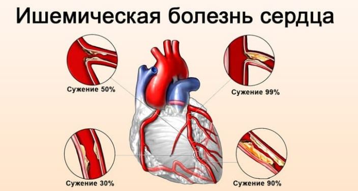 Ишемическая болезнь сердца