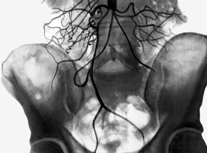 Рис. 3. Аортограмма при высокой окклюзии брюшной части аорты: видны многочисленные коллатерали, берущие начало выше уровня окклюзии аорты