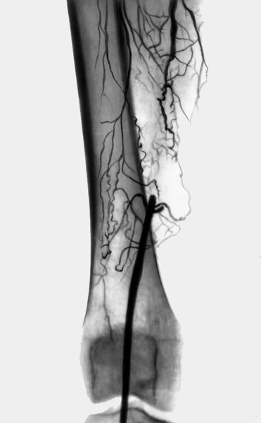 Рис. 1. Ангиограмма бедренной артерии при сегментарной ее окклюзии: видны перерыв заполнения бедренной артерии рентгеноконтрастным веществом и многочисленные коллатерали