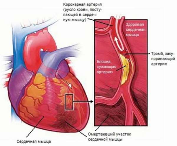 Клинические отличия Q образующего инфаркта миокарда и некроза без патологического зубца