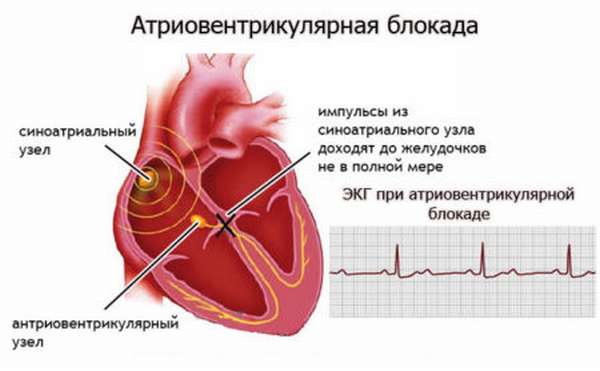Перечень видов аритмии сердца, отличия, характерные симптомы, диагностика и лечение