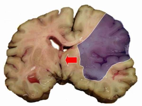 Показания к проведению операции при инсульте головного мозга