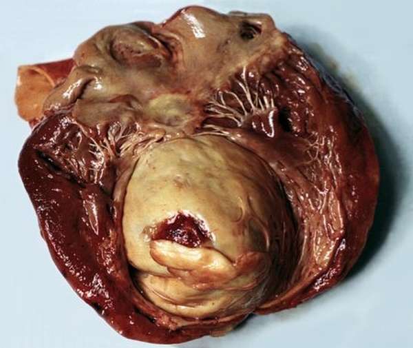 Развитие аневризмы сердца после инфаркта, прогнозы и рекомендации врачей