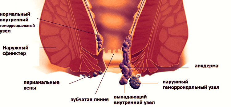 При каких случаях геморроя показан Ультрапрокт