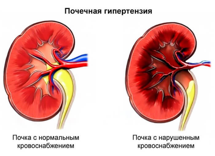 Почечная ГИПЕРТОНИЯ: Кто виноват и ЧТО делать?